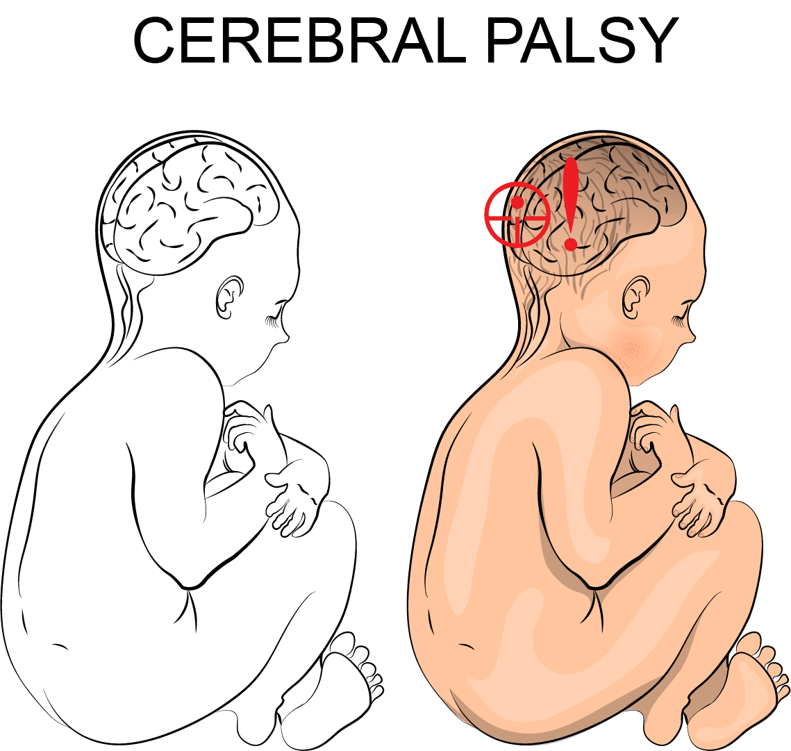 cerebral palsy; neonatal brain damage; CP; birth injury; disability; special needs