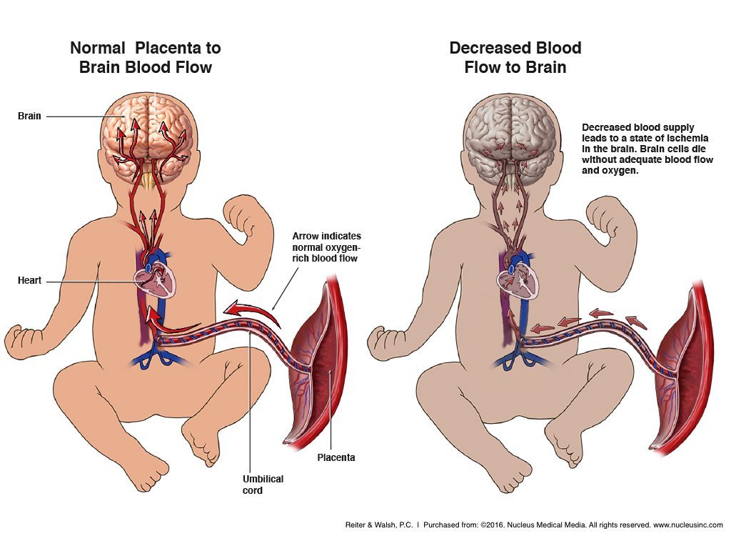 Long-Term Effects of Birth Asphyxia and Hypoxic Ischemic Encephalopathy