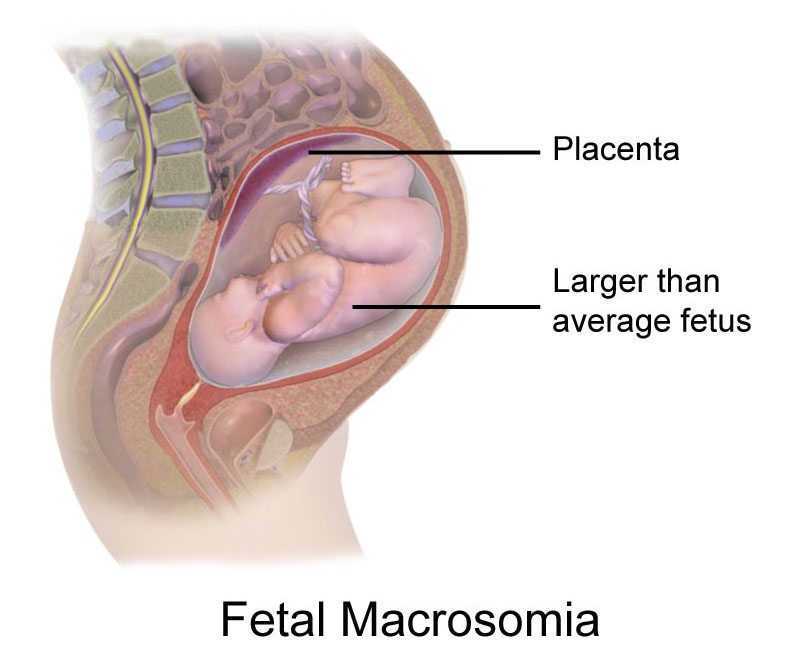 fetal macrosomia