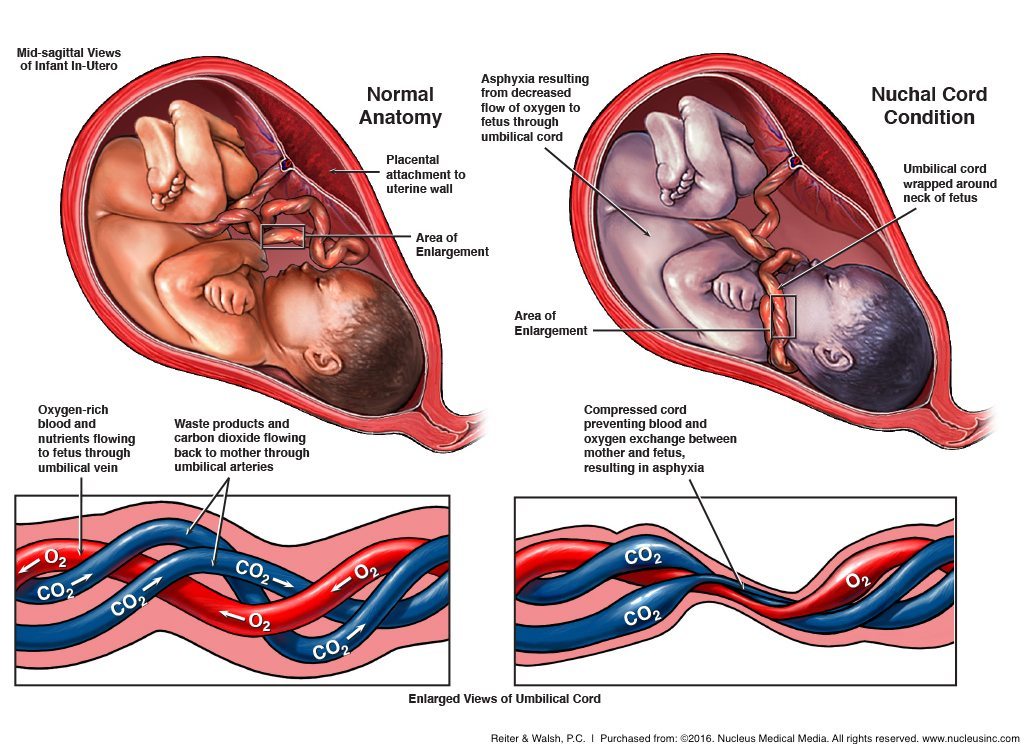 Nuchal Cords Can Cause Encephalopathy