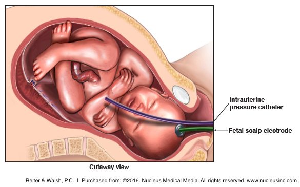 internal fetal monitoring; fetus; pregnancy