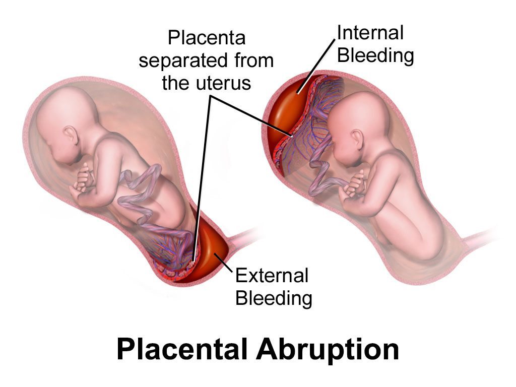 Placental Abruption