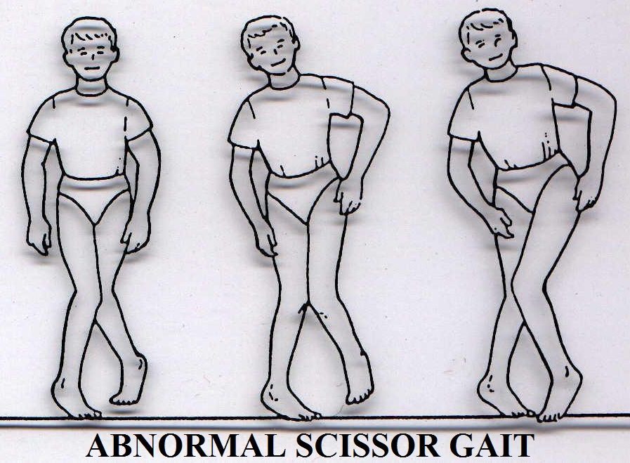 scissor gait