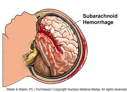 subarachnoid hemorrhage