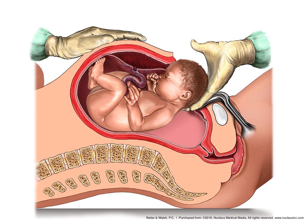 c-section