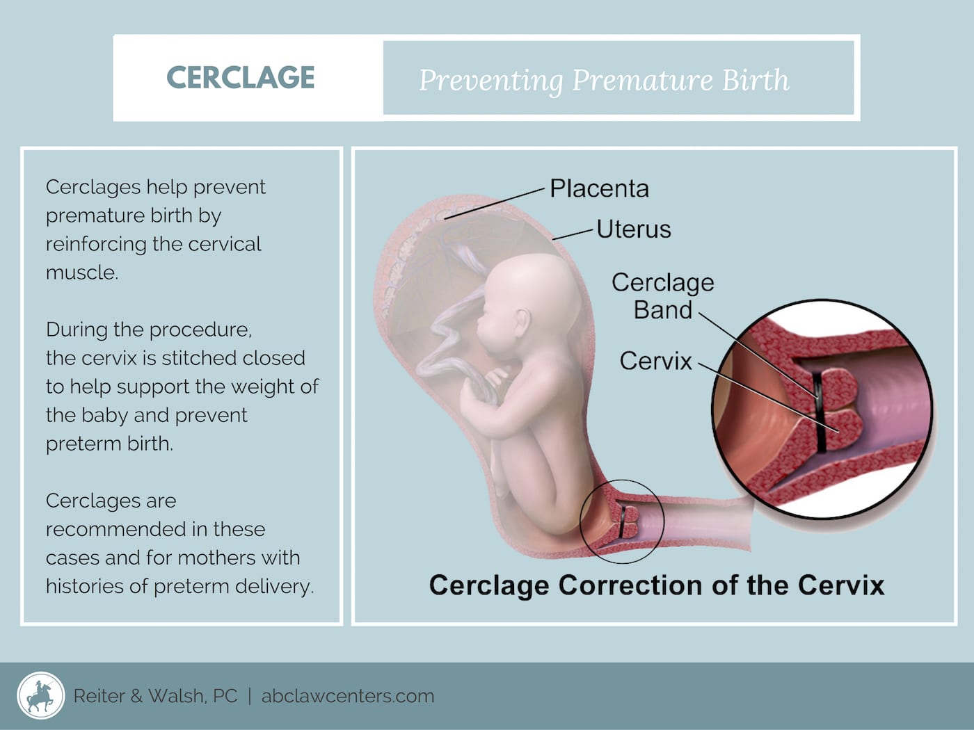 cervical cerclage