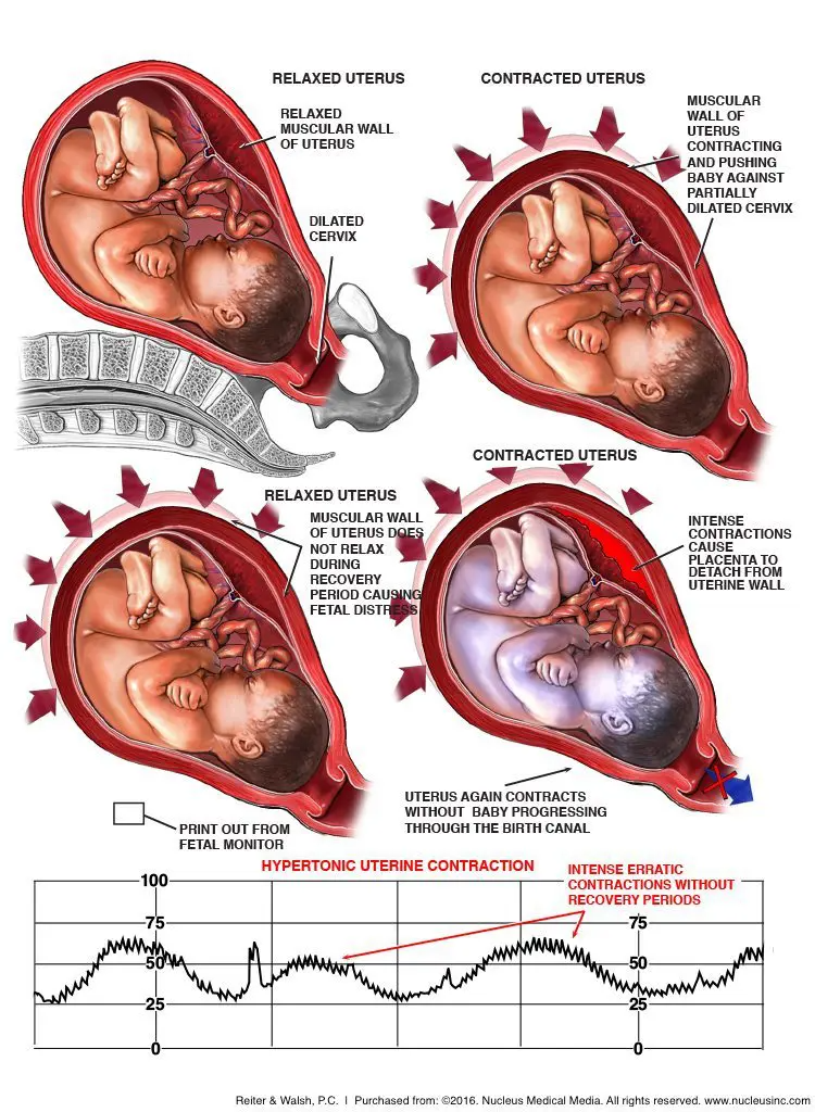 Excess uterine activity like frequent or strong contractions can appear on a fetal monitor strip as a series of sharp, jagged lines.