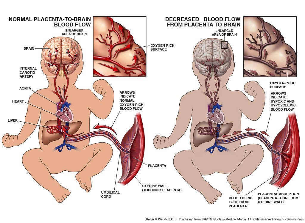 neonatal brain damage; fetal hypoxia; hypoxic ischemic encephalopathy, HIE; birth asphyxia; neonatal encephalopathy, intrapartum asphyxia; fetal oxygen deprivation; placenta; pregnancy; placental abruption; hypovolemic blood flow