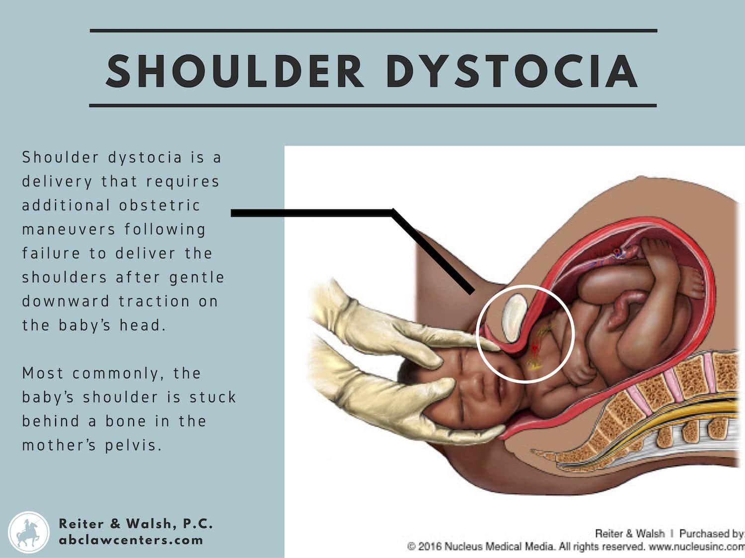 Shoulder Dystocia and Brachial Plexus Injury