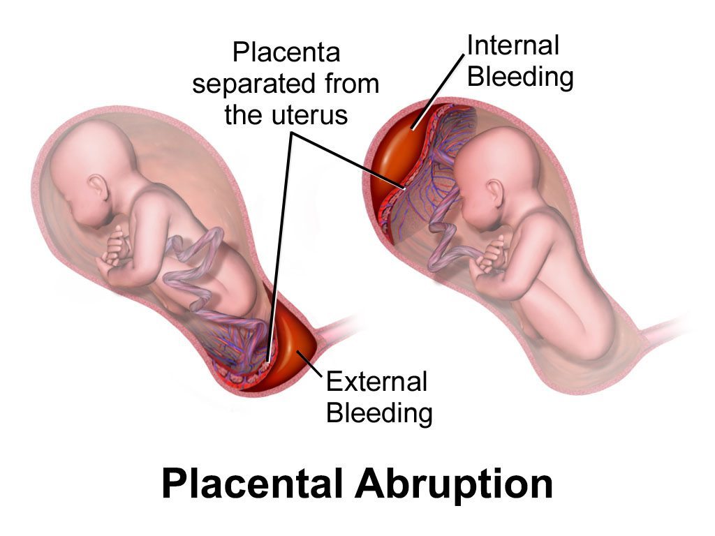 Two figures of a baby in the uterus show how both internal bleeding in the uterus and external bleeding outside of it can cause the placenta to separate from the uterus. This can cause placental abruption.