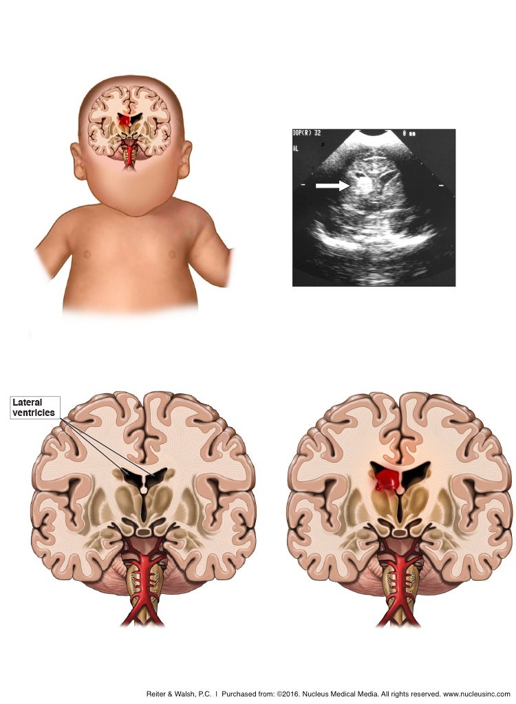 Fetal brain hemorrhage, intracranial hemorrhage, neonatal brain damage