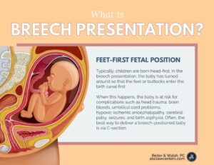 Breech Baby C-Section Delivery | Frank Breech Baby Presentation