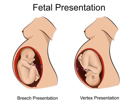 Delivering Breech Babies by C-Section: Medical illustration of fetal presentation