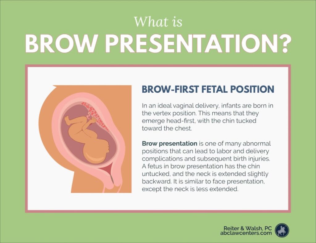 face and brow presentation