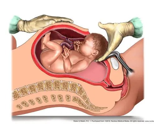 A Delayed Emergency C-Section Can Cause Birth Injuries Such As Cerebral Palsy