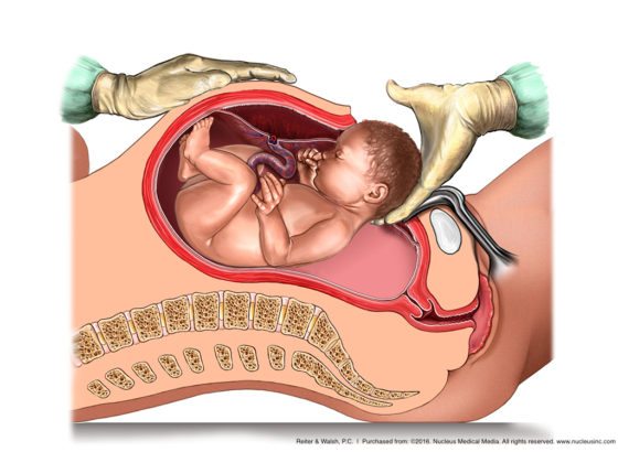 C-section for breech presentation (breech babies)