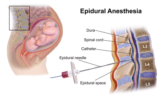 Epidural anesthesia, childbirth and birth injury
