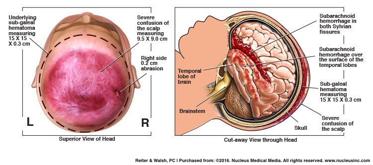 subgaleal hematoma; neonatal brain damage; subarachnoid hemorrhage; intracranial hemorrhage