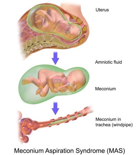 Meconium Aspiration Syndrome (MAS) and Birth Injury