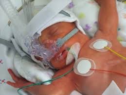 Newborn baby with nasal CPAP for a birth injury in the neonatal intensive care unit (NICU)