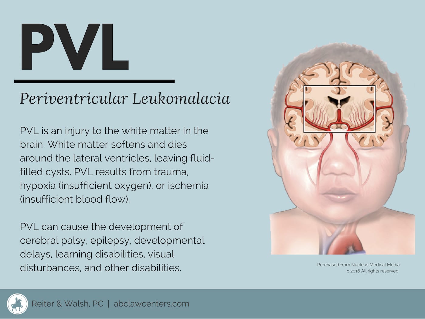 Periventricular Leukomalacia