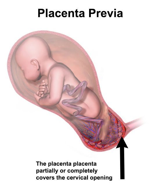 illustration of a placenta covering the cervical opening
