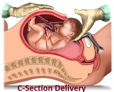 C-section fetal acidosis