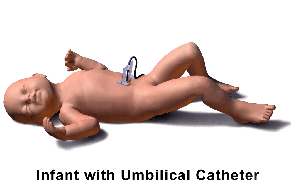 Umbilical catheter; NICU; baby; infant