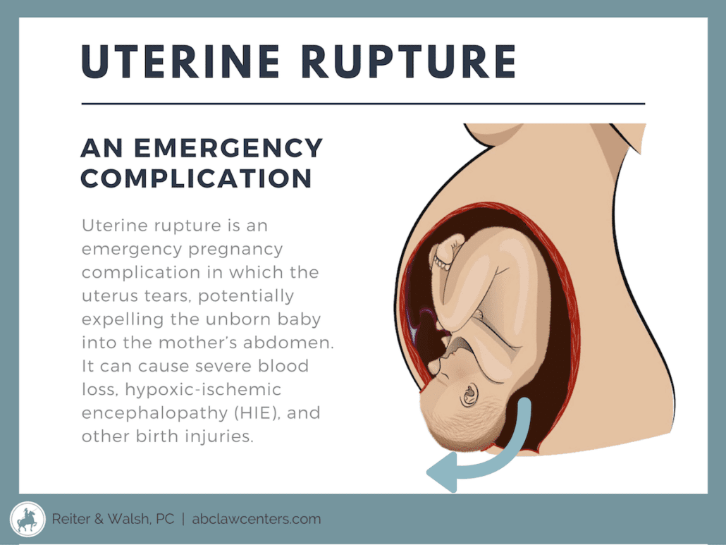 Uterine Rupture