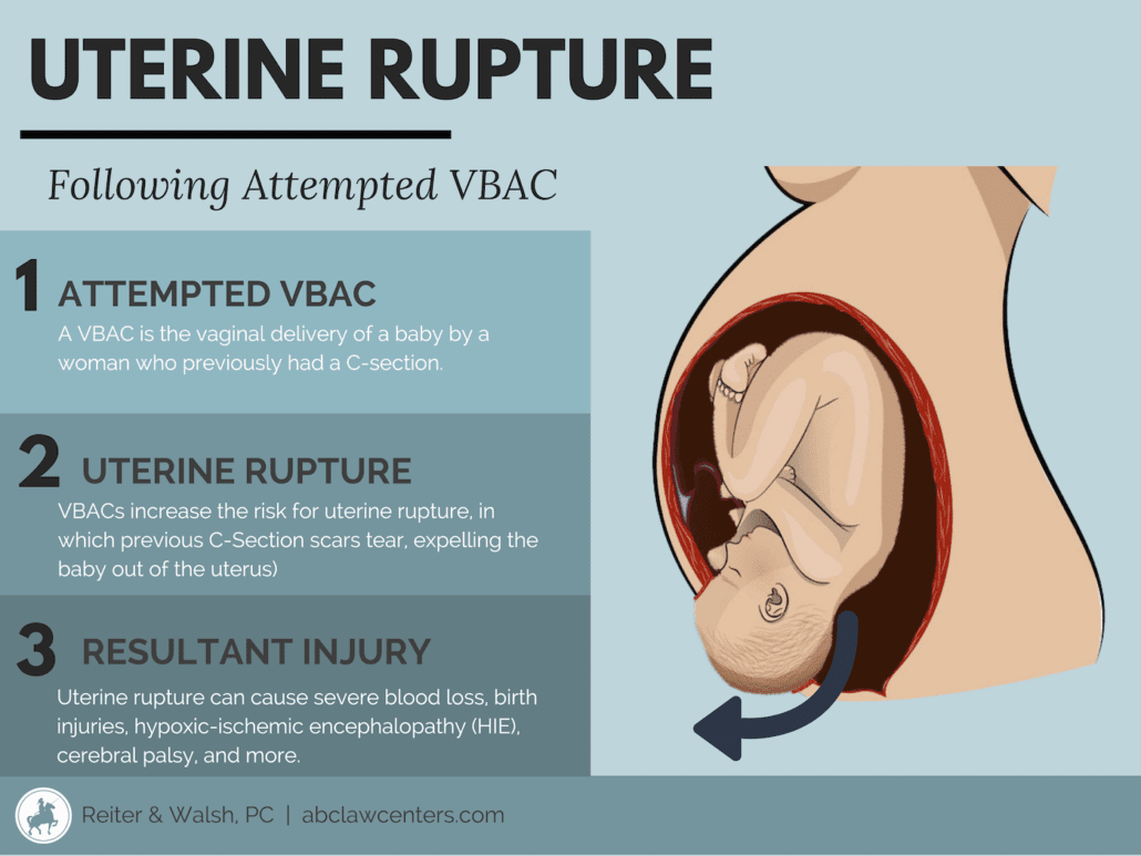 Uterine Rupture from VBAC (Vaginal Birth After C-Section)