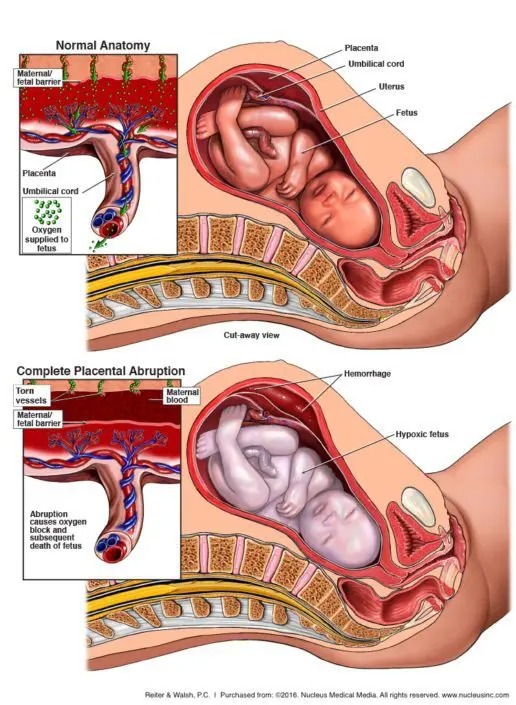 picture comparing the normal anatomy of a pregnant mother and anatomy of a pregnant mother where placental abruption has occurred.
