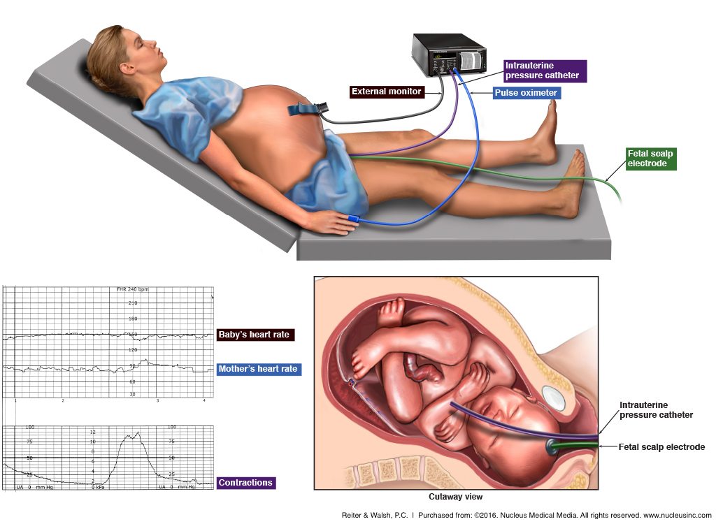 Labor monitoring with an external monitor, intrauterine pressure catheter, pulse oximeter and fetal scalp monitor