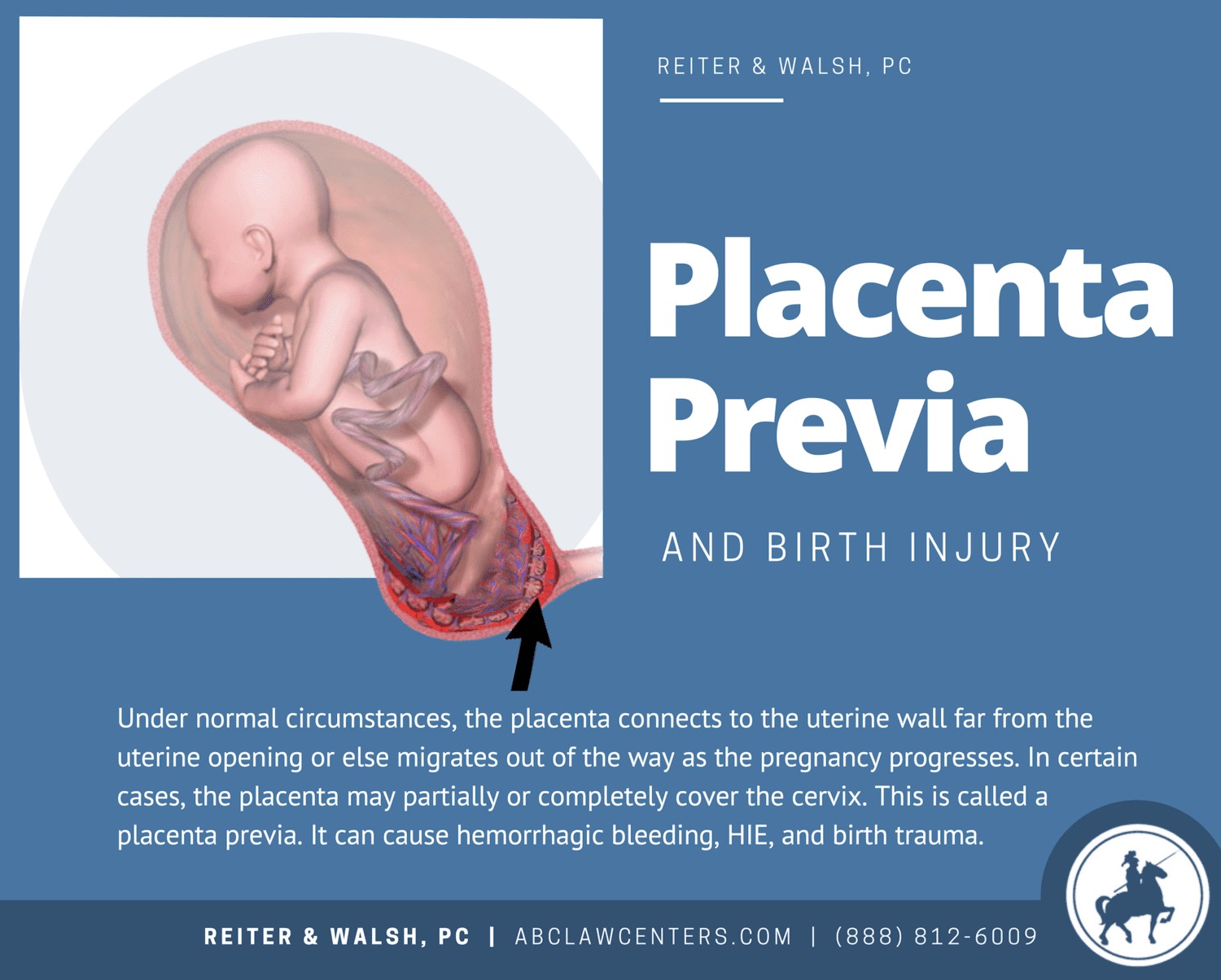 An illustration of a baby in the womb experiencing placenta previa