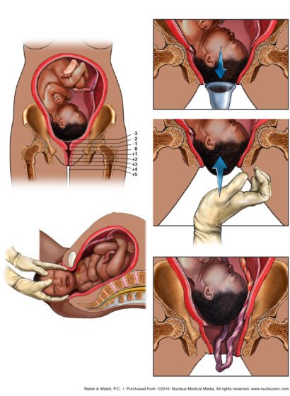 umbilical cord prolapse