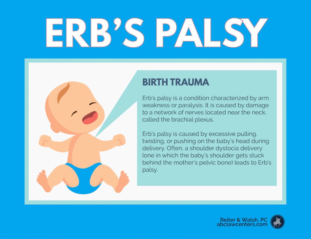 erb's palsy