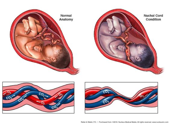 nuchal cord anatomy