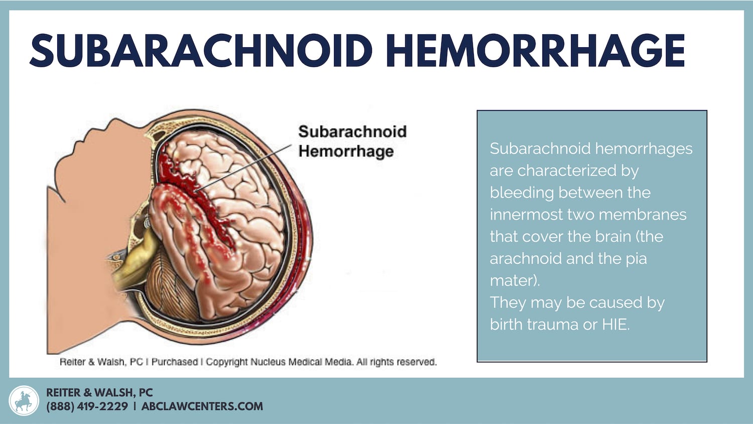 subarachnoid hemorrhage