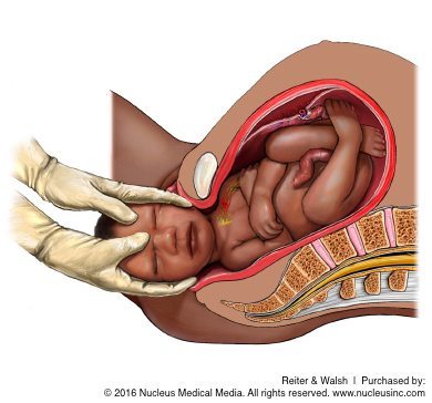 erb's palsy and brachial plexus injuries