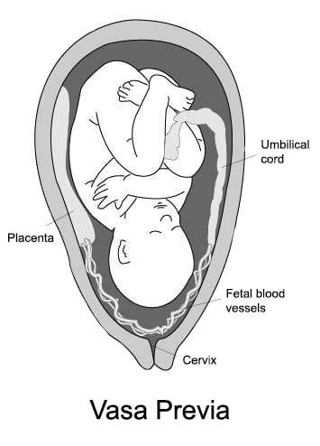 vasa previa