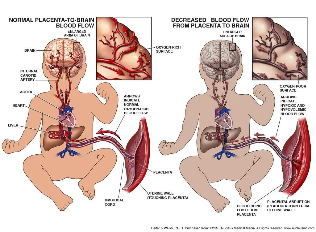 Hypoxic Ischemic Encephalopathy (HIE), Birth Asphyxia, Neonatal Encephalopathy