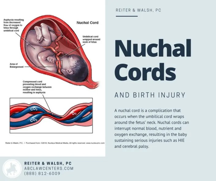 Nuchal Cords and Birth Injury