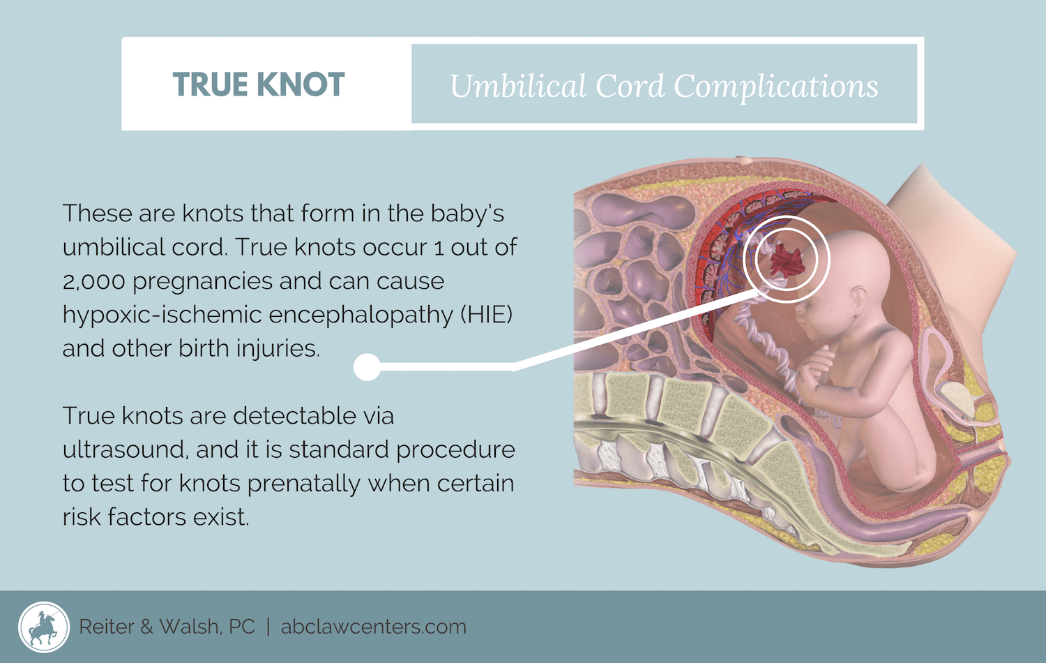 true knot in the umbilical cord